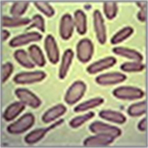 Hereditary elliptocytosis: MedlinePlus Medical Encyclopedia.